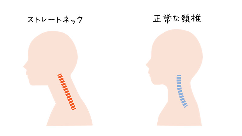 ストレートネック/正常な頸椎