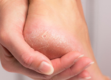 【医師監修】かかとがガサガサする原因、おすすめの角質ケア方法解説