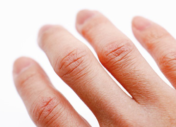 【医師監修】ツライひび・あかぎれはなぜ起きる?症状と原因、セルフケアを解説