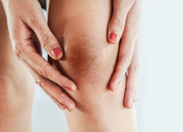 【医師監修】ひざの黒ずみの原因とは?消す・治す方法とともに解説