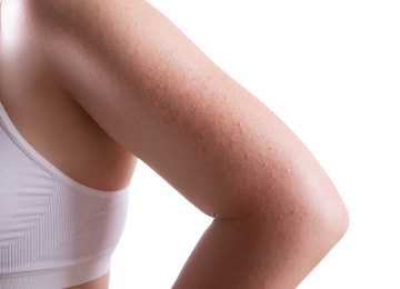 さめ肌(鮫肌)の原因と改善法とは?腕やおしり太ももの急なザラつきを治す方法を医師が解説