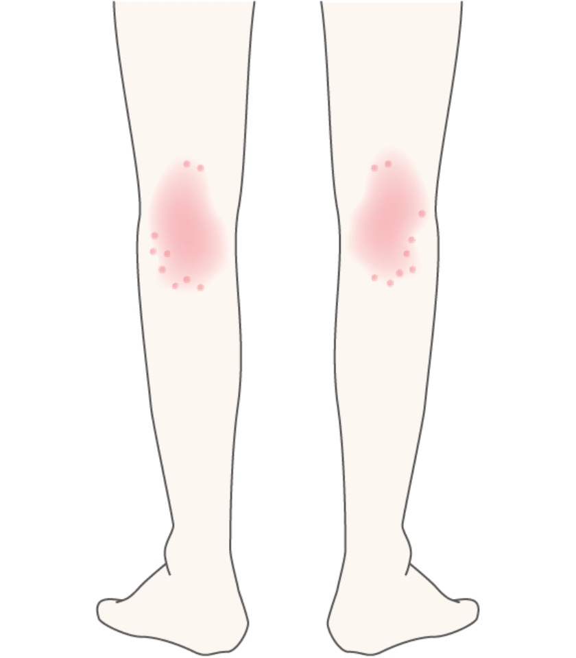 アトピー性(せい)皮膚炎(ひふえん)