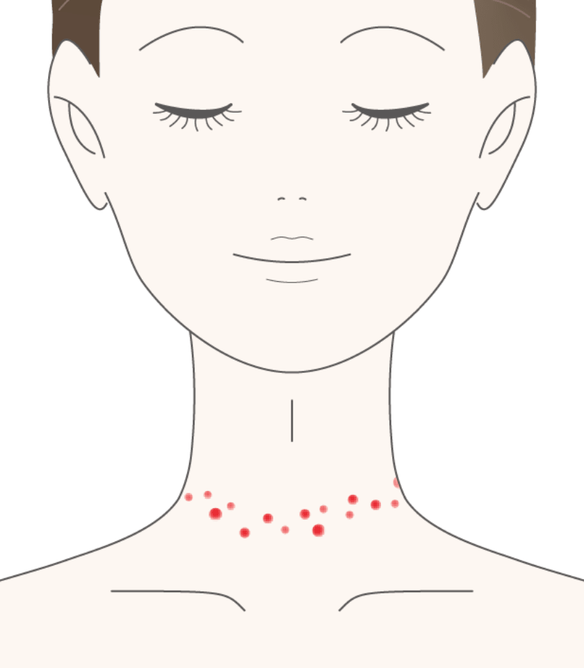 接触(せっしょく)皮膚炎(ひふえん)