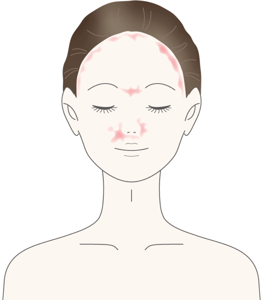 脂漏性(しろうせい)皮膚炎(ひふえん)