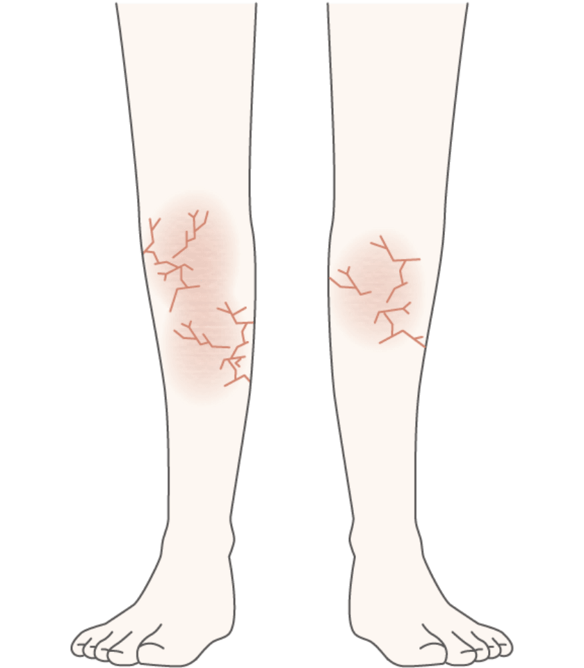 皮脂欠乏性湿疹湿疹(ひしけつぼうせいしっしん)（乾燥湿疹(かんそうしっしん)）