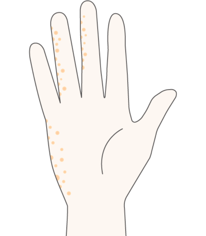 汗疱(かんぽう)（異汗性(いかんせい)湿疹(しっしん)）