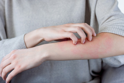 湿疹とは？皮膚炎が起こる原因や症状の種類を解説