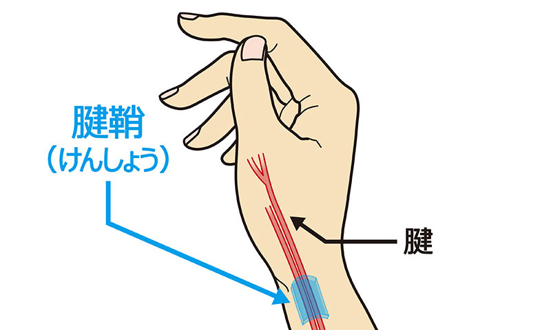 手指や手首に起こる「腱鞘炎」のメカニズム